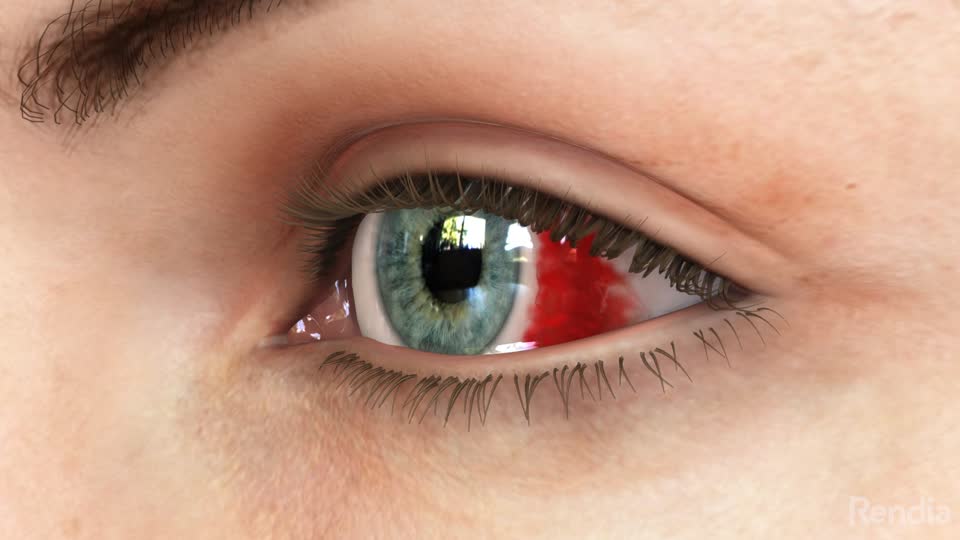 Close up of green eye with bleeding on the eye ball