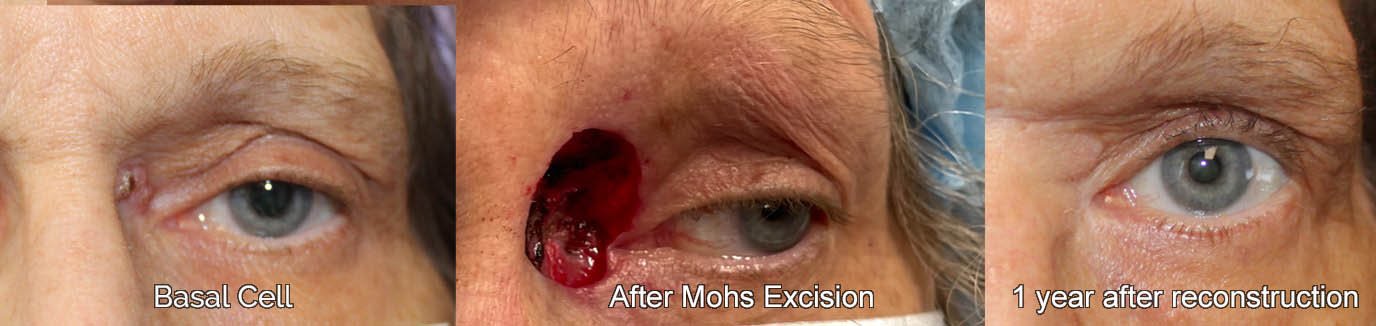 results of mohs excision on the inner eyelid