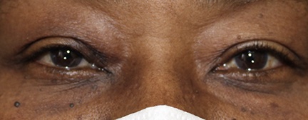 after ptosis repair on female patient results