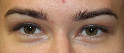 32 year old woman after blepharoplasty surgery