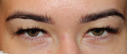 32 year old woman before upper blepharoplasty surgery