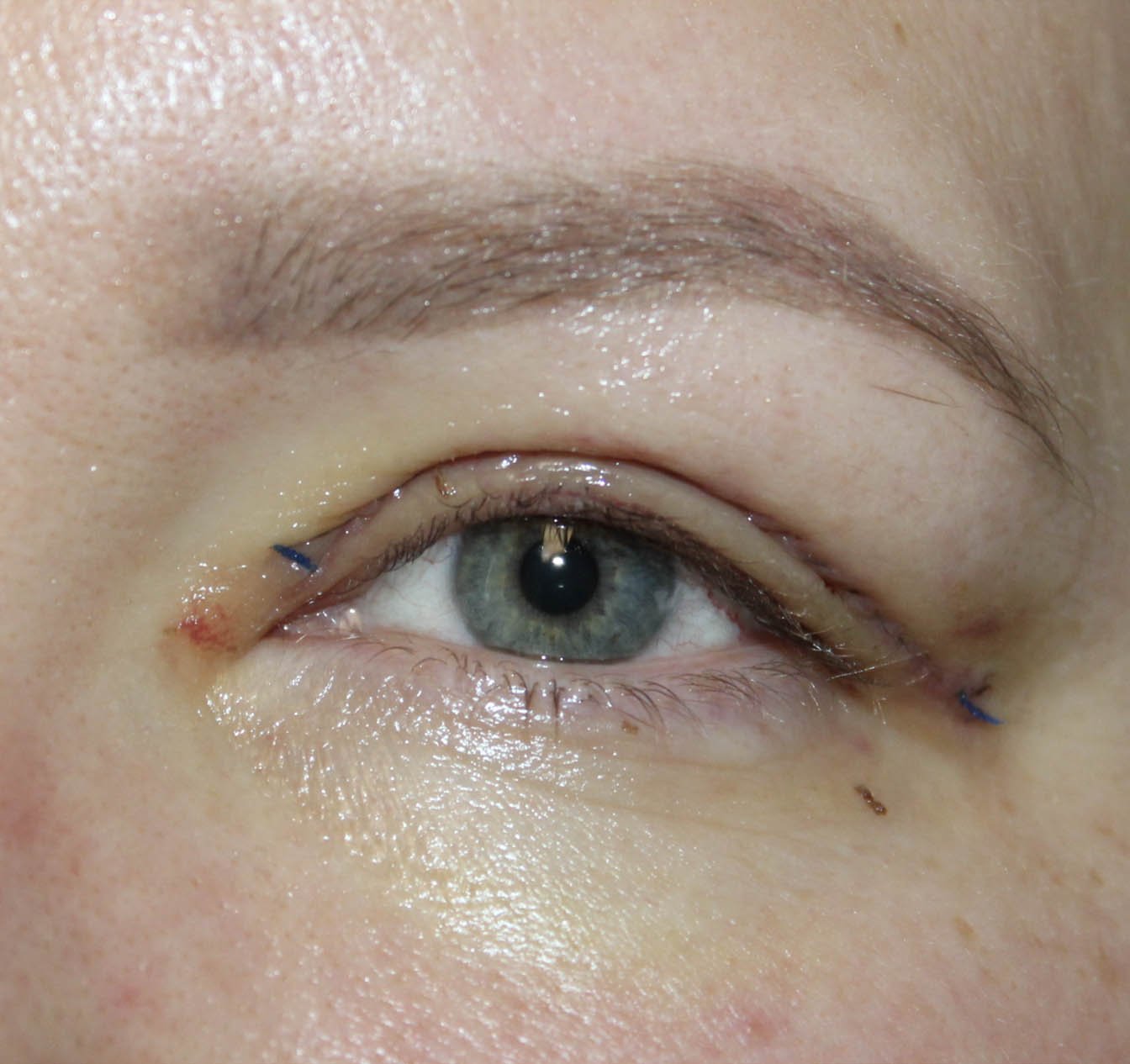 woman open eyes 38 years old 1 week after upper blepharoplasty procedure