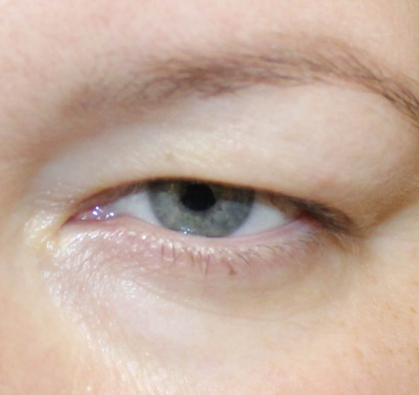 woman before upper blepharoplasty 38 years old