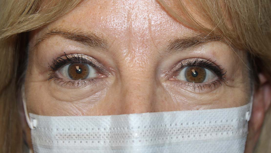 50 year old woman front facing after blepharoplasty on eyelid