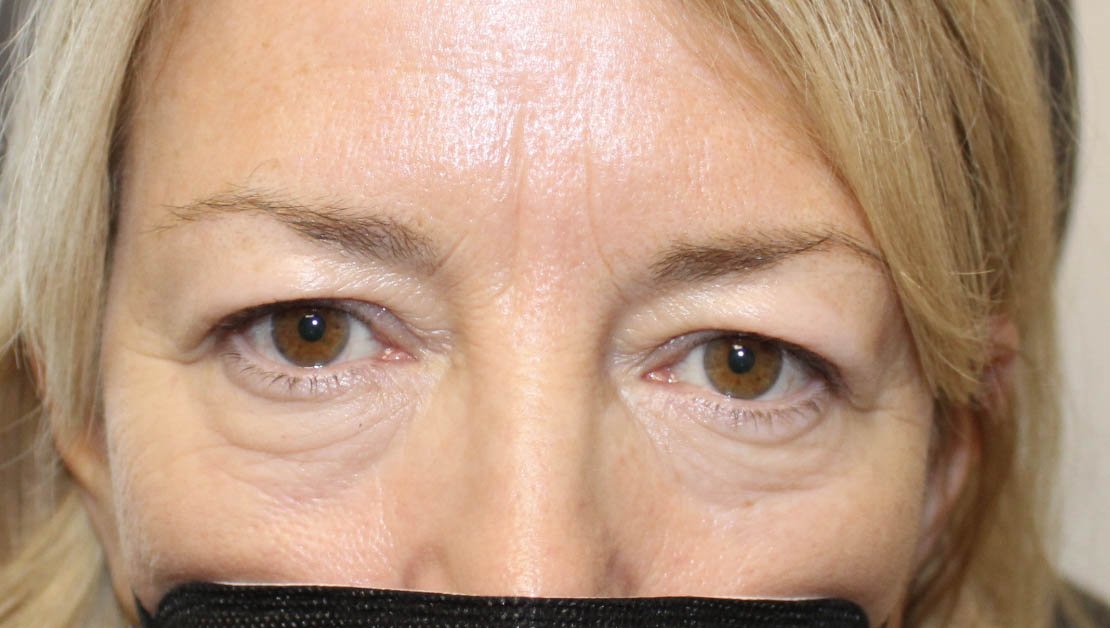 50 year old woman before blepharoplasty on upper eyelid