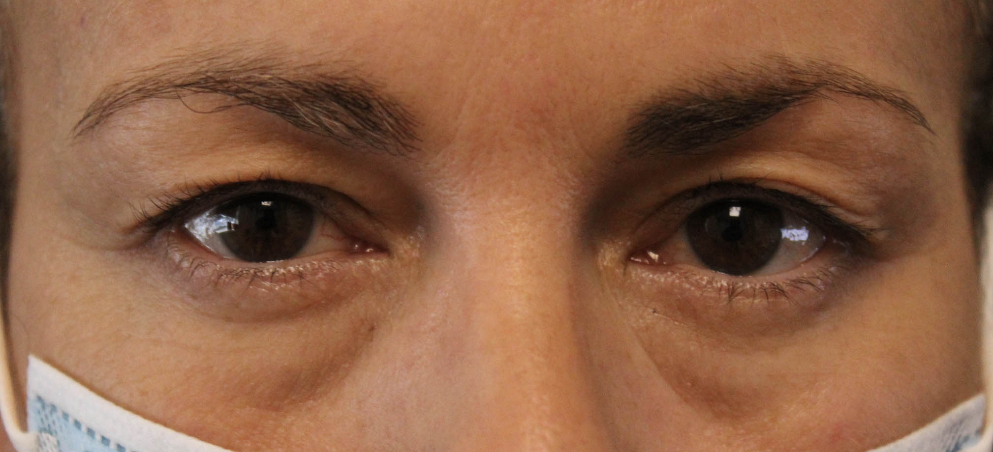 woman looking straight ahead after upper and lower blepharoplasty eye surgery