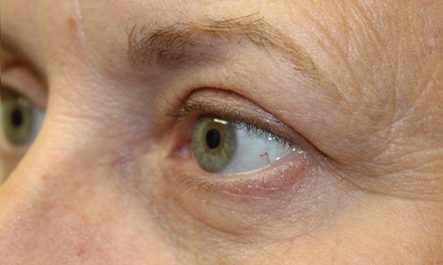 55 year old woman quad blepharoplasty upper results