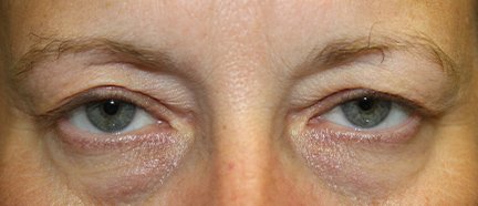55 year old woman before blepharoplasty