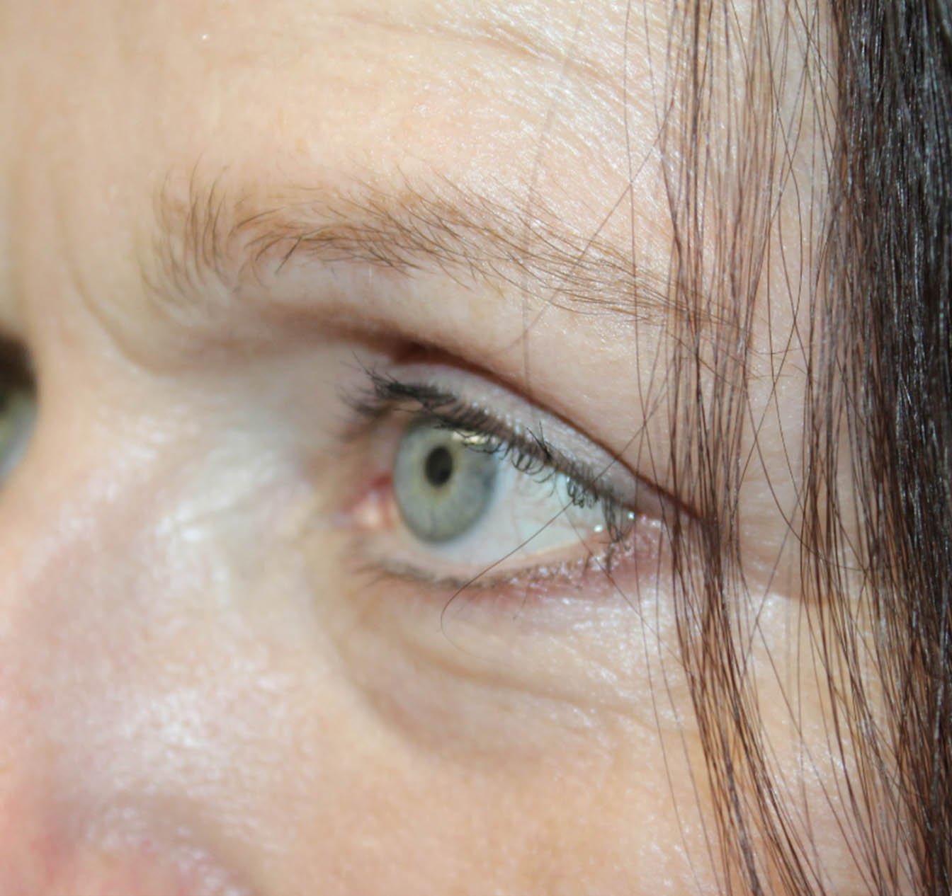 55 year old left eye after blepharoplasty