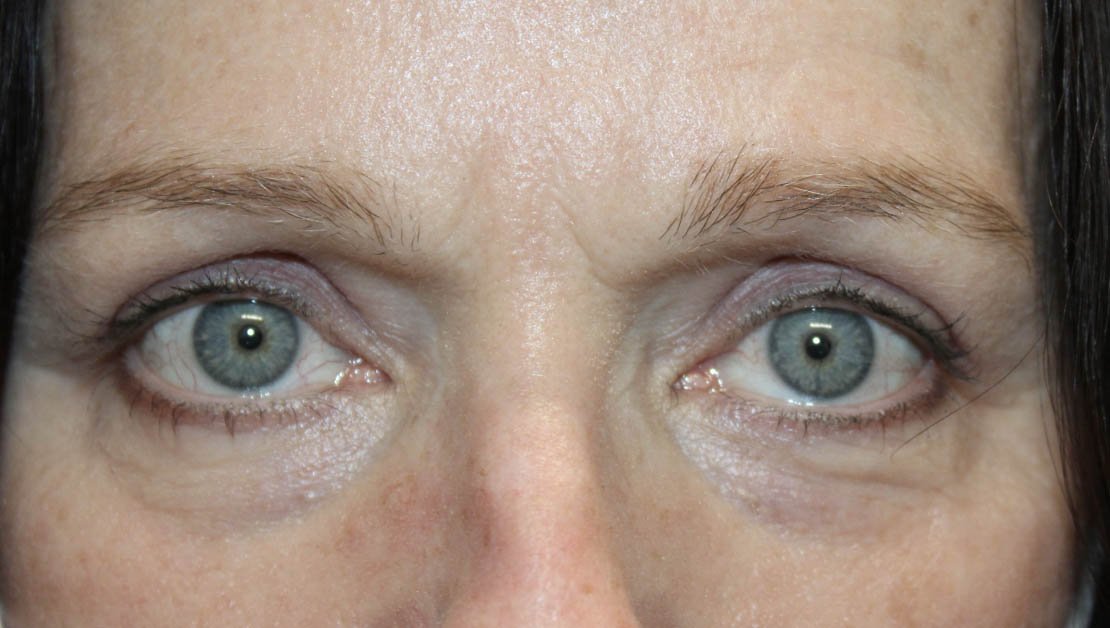 55 year old frontal face after blepharoplasty surgery