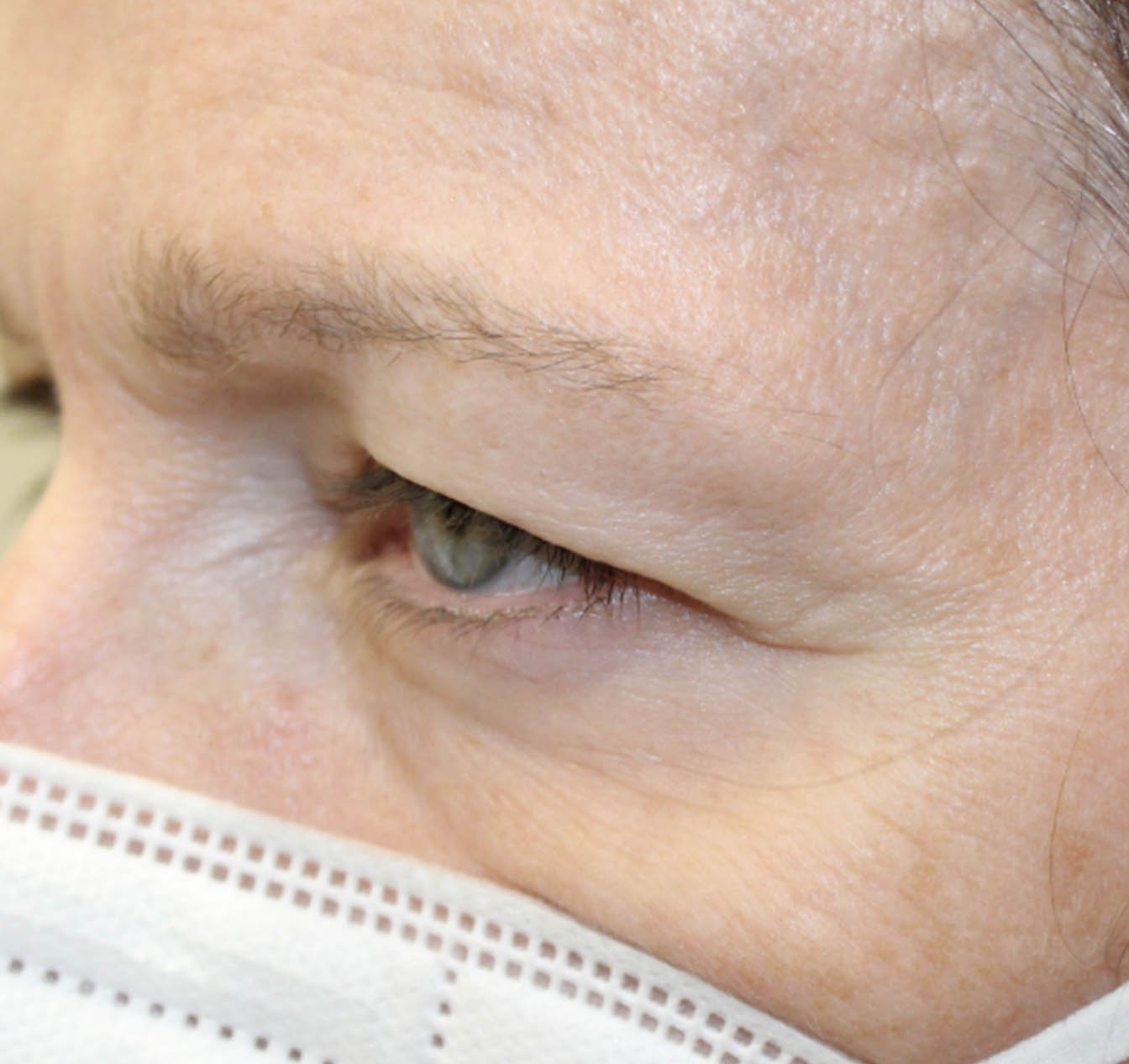 55 year old female left eye before upper eye blepharoplasty