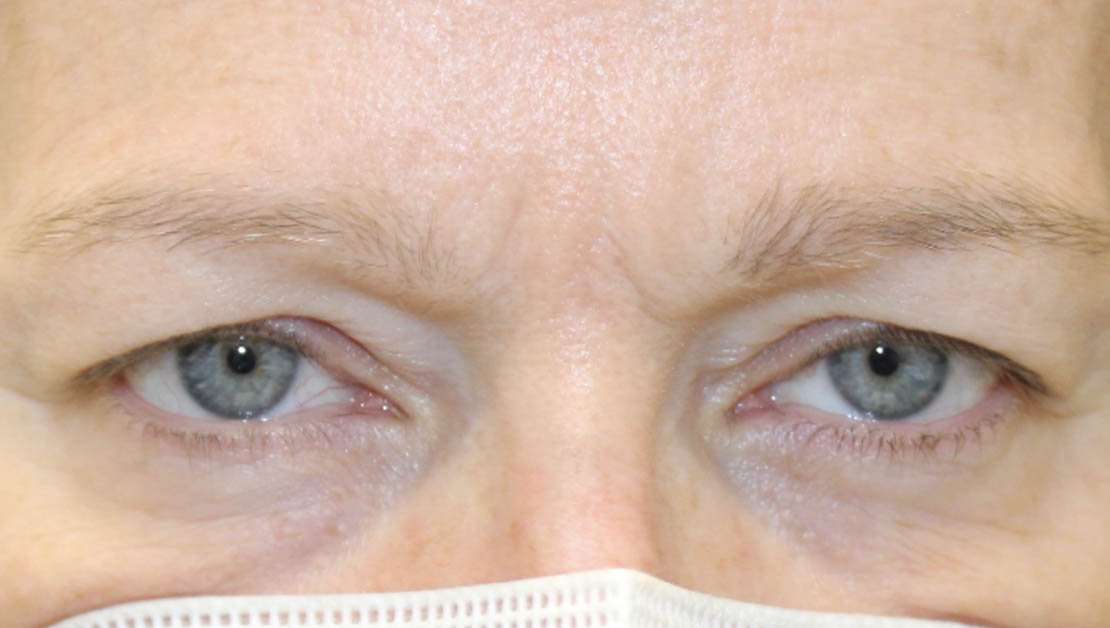 55 year old woman before blepharoplasty frontal facing
