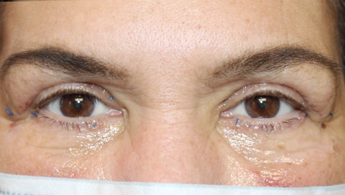 56 year old female frontal facing results of blepharoplasty