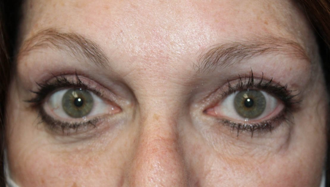 56 year old woman front facing after upper blepharoplasty surgery