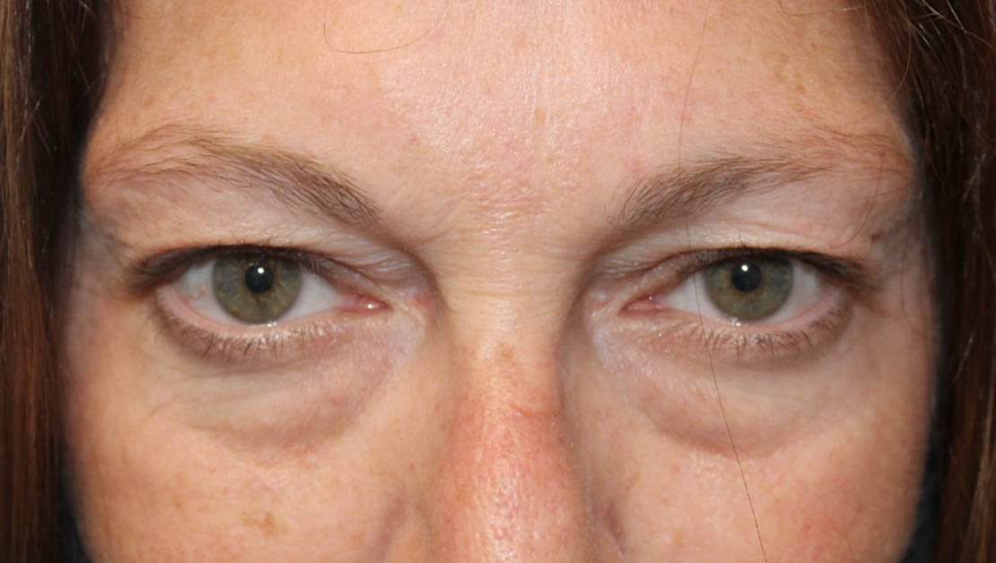 56 year old frontal facing before blepharoplasty