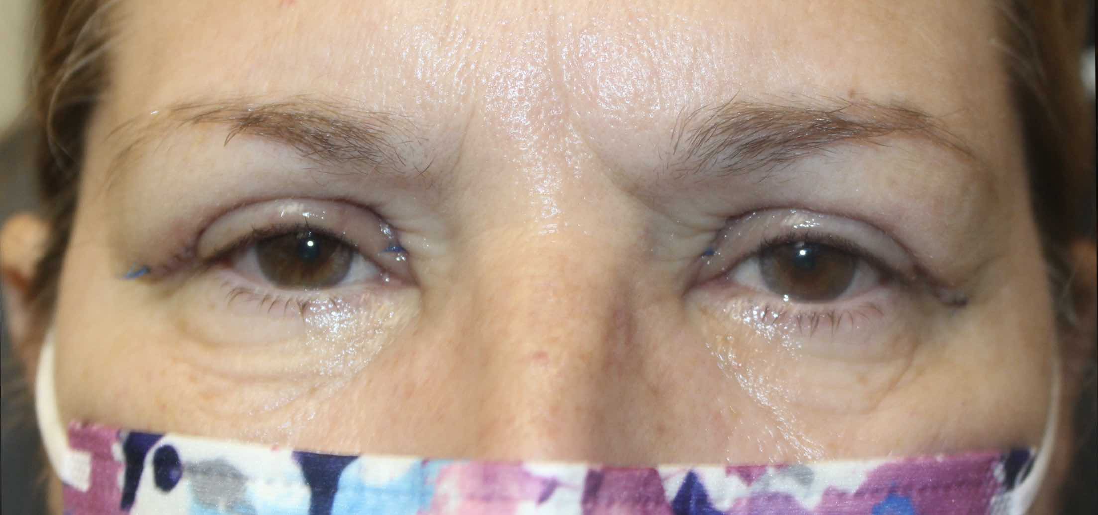 57 year old female patient 1 week after blepharoplasty