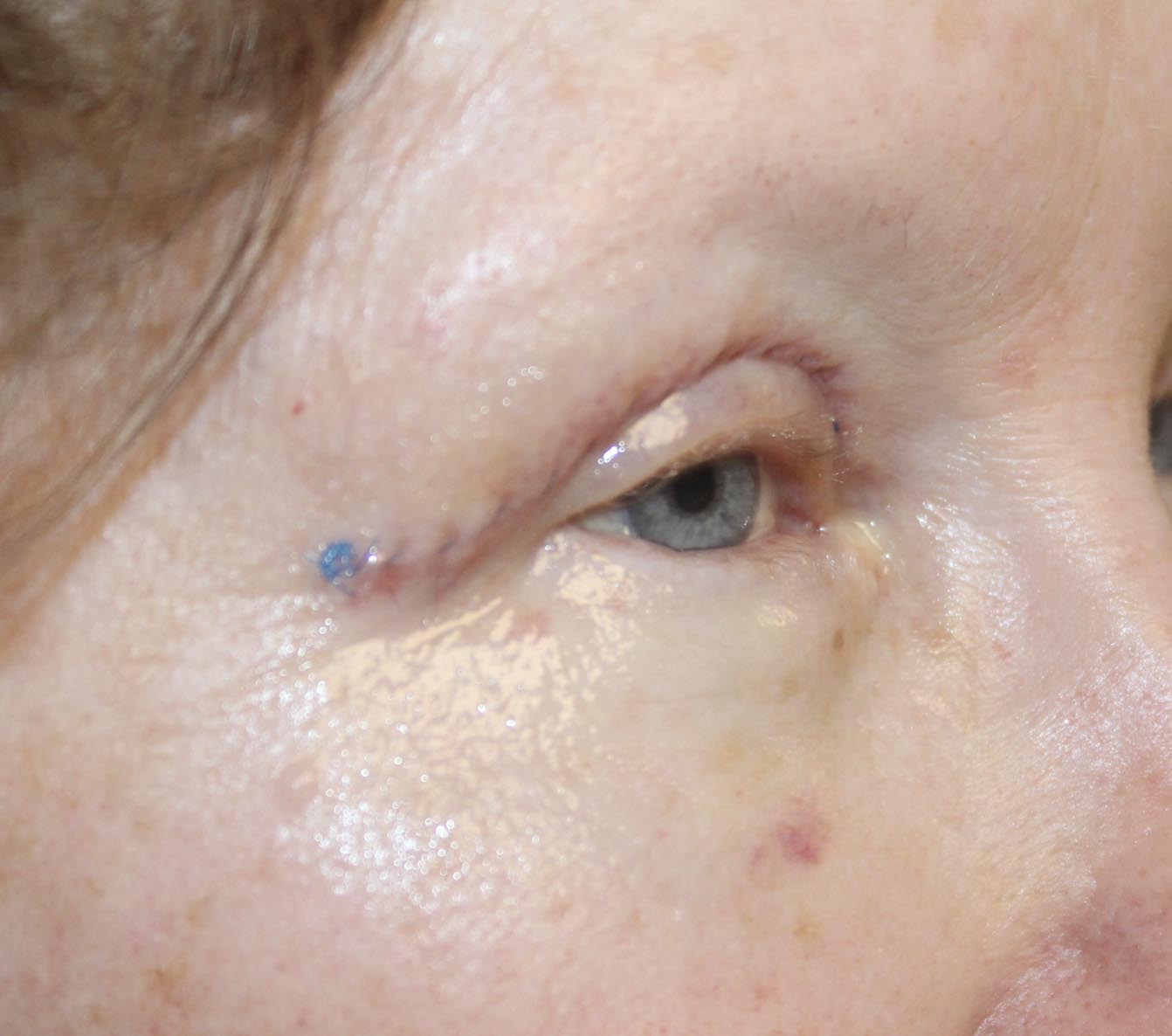 woman after lower blepharoplasty procedure 57