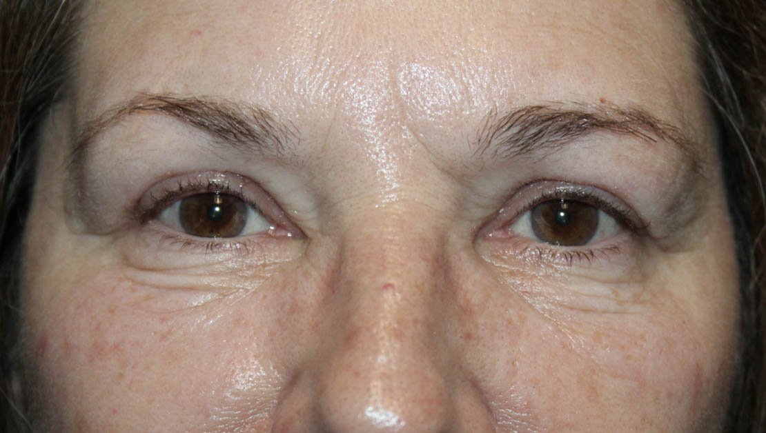 57 year old female after blepharoplasty surgery