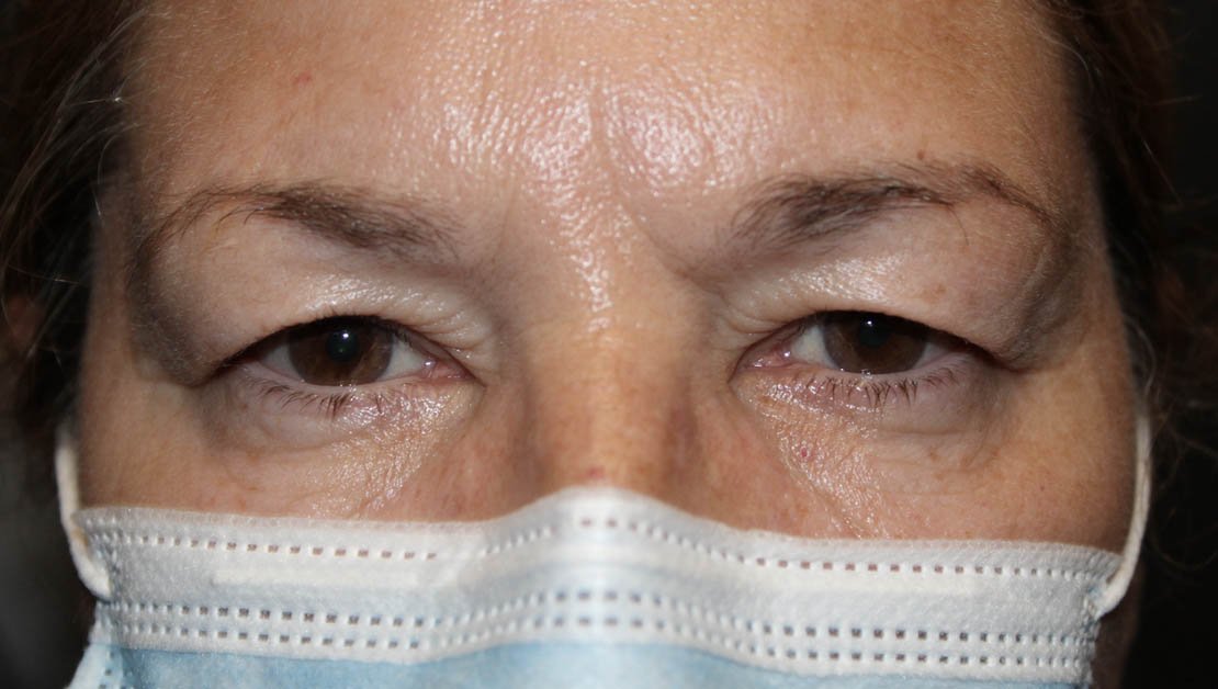 57 year old female before blepharoplasty surgery front facing