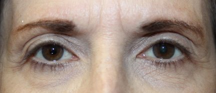 59 year old woman ptosis repair results