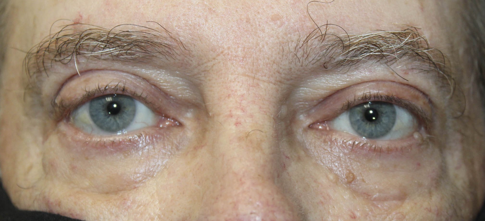 59 year old male external ptosis repair after