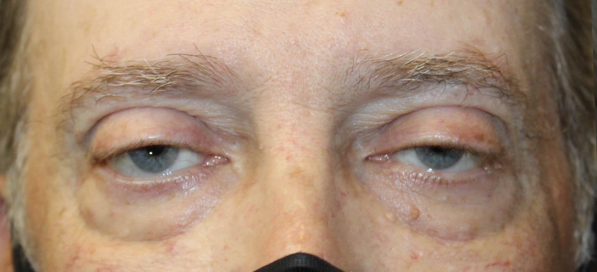 male patient before ptosis repair surgery