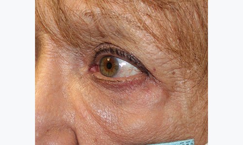 Woman's right eye after receiving injections
