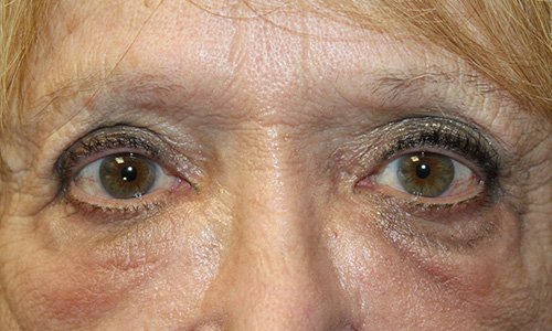 Older woman both eyes after receiving doxycycline injection