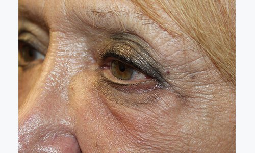 older womans eye after doxycycline injection