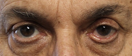 60 year old male after ectropion eyelid repair surgery