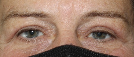 60 year old female after blepharoplasty procedure