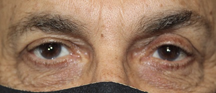 60 year old male ectropion surgery example