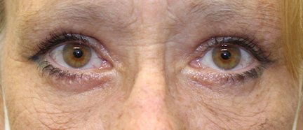 61 year old woman after blepharoplasty surgery