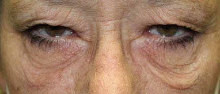 61 year old woman before blepharoplasty procedure