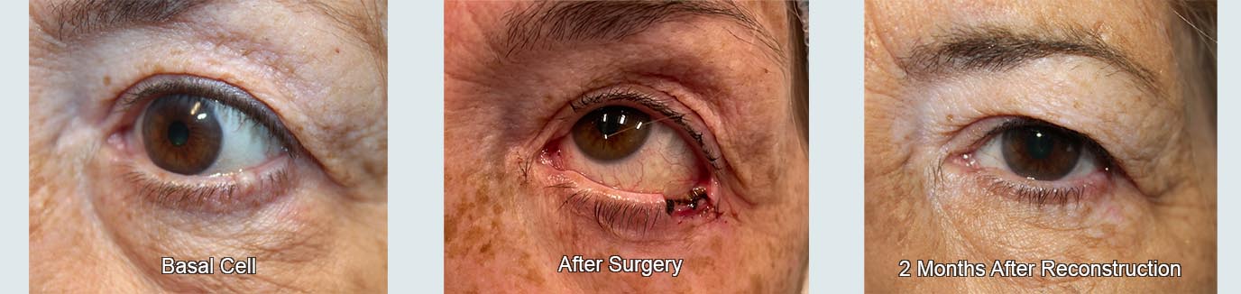 mohs surgery removing basal cell on the lower eyelid