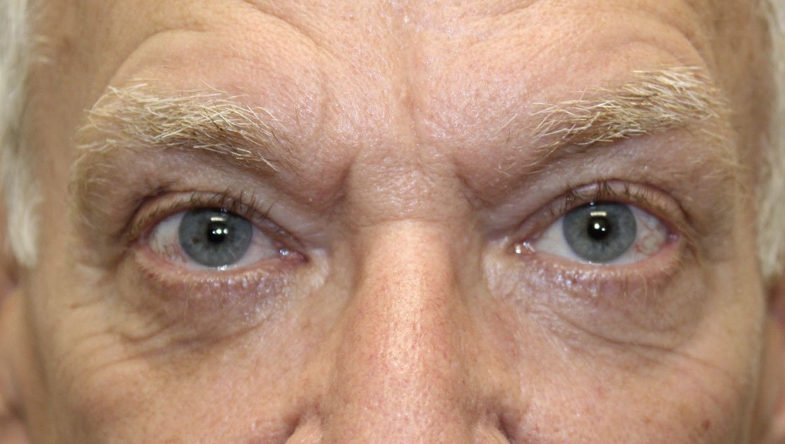 64 year old man after receiving lower blepharoplasty