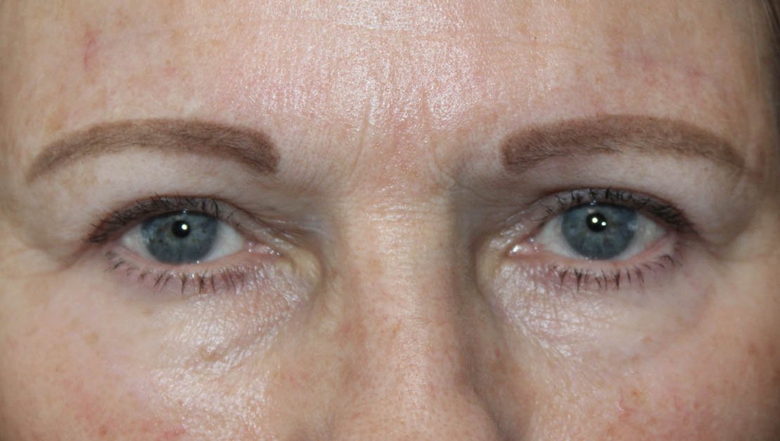 67 year old female looking forward after upper blepharoplasty