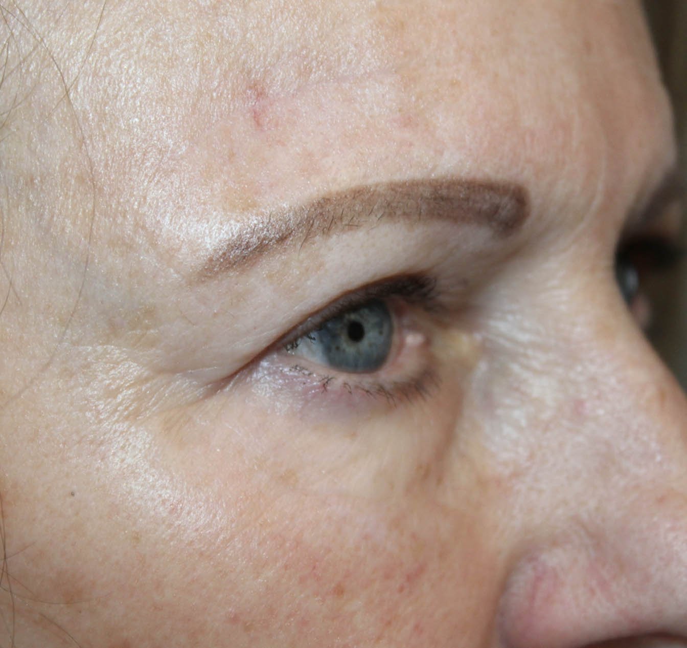 left eye side facing after blepharoplasty surgery results