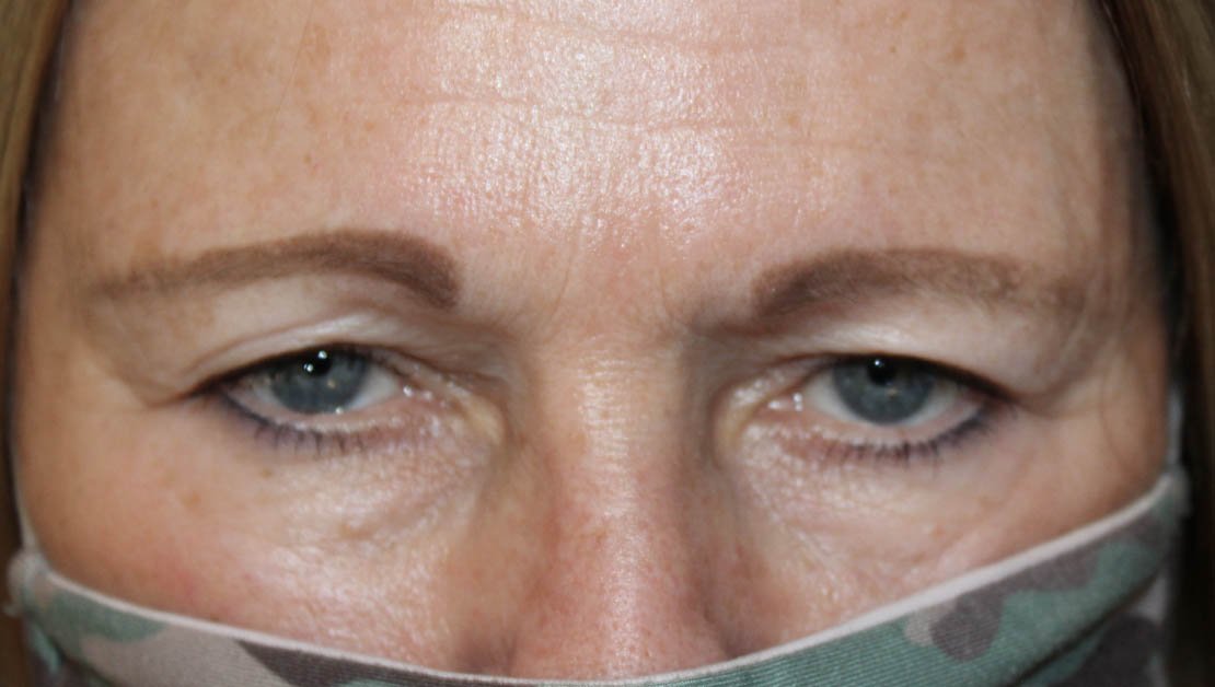 67 year old frontal facing female before upper blepharoplasty surgery