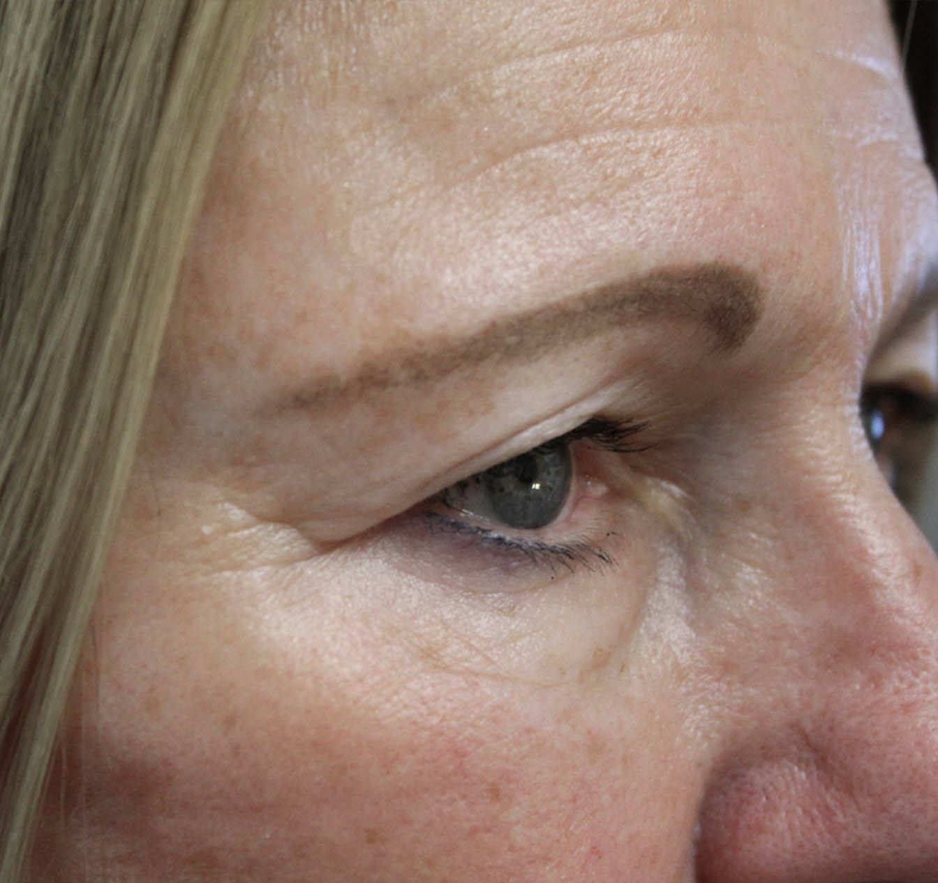 67 year old female patient before blepharoplasty of upper eye side facing