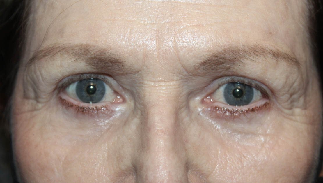 68 year old both eyes after blepharoplasty