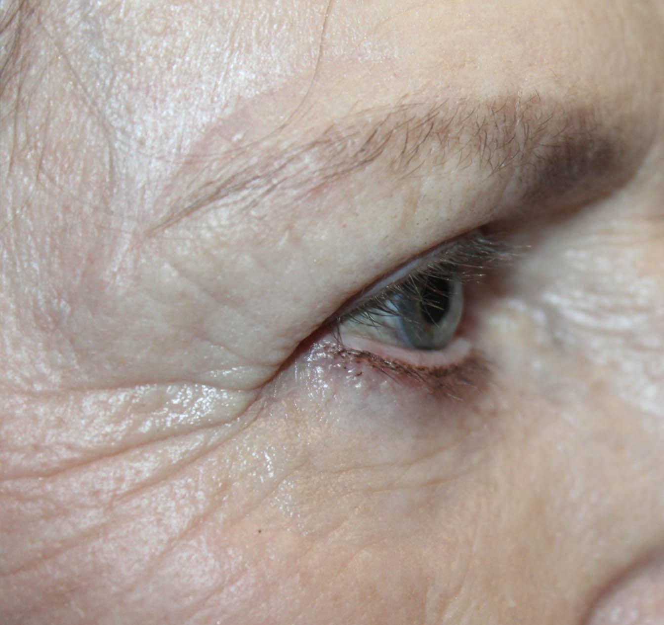 68 year old right eye after blepharoplasty