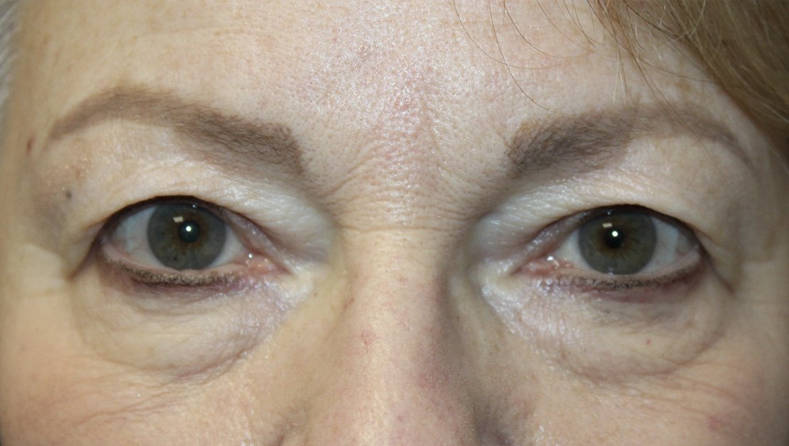 woman after blepharoplasty procedure 69 years old results