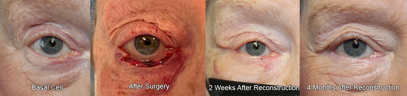 70 year old woman before, during, and after basal cell removal