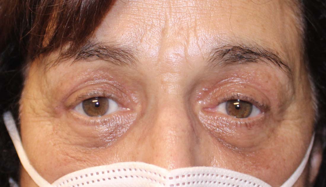 After ptosis eyelid surgery on woman 70 years old