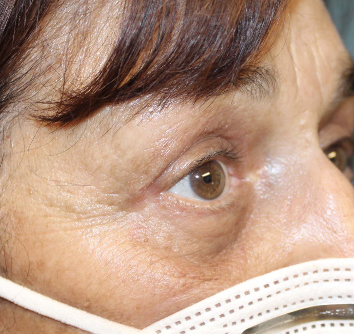 70 year old woman side view after blepharoplasty results
