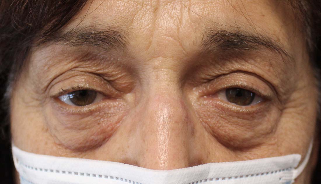 70 year old woman before blepharoplasty eye surgery
