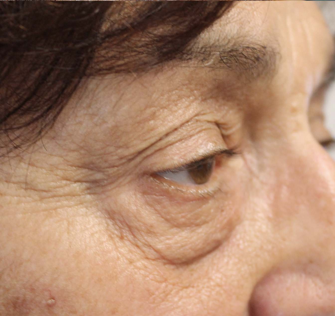 before ptosis eye surgery on woman 70 years old
