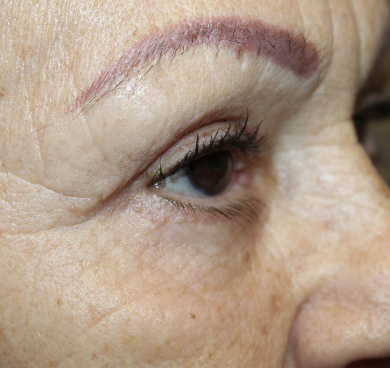 70 year old side facing left eye after blepharoplasty