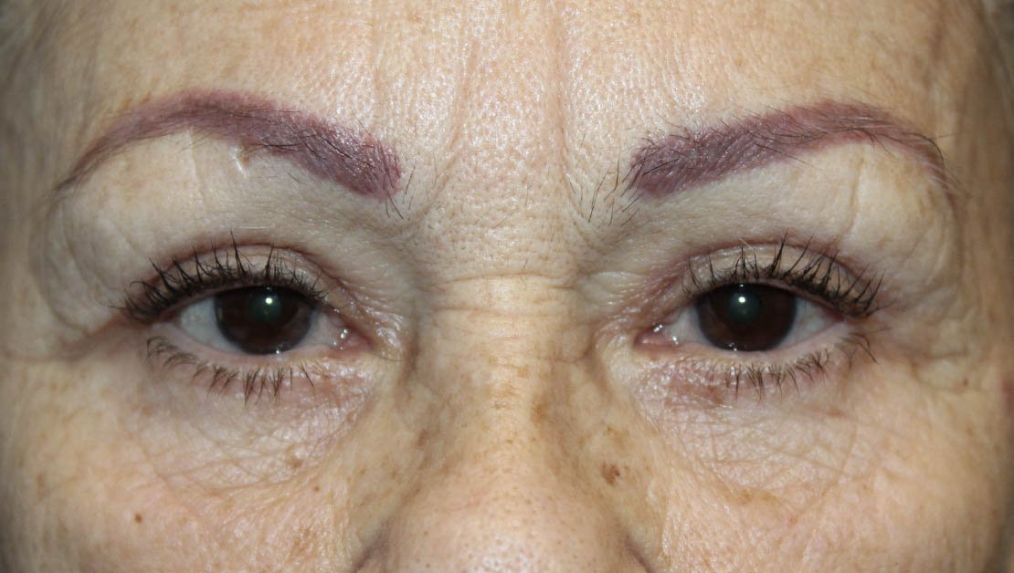 70 year old female after blepharoplasty front facing